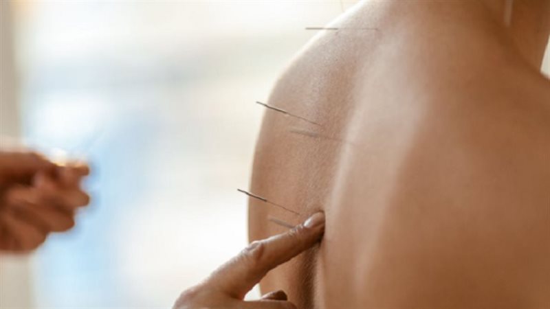 الوخز بالإبر 