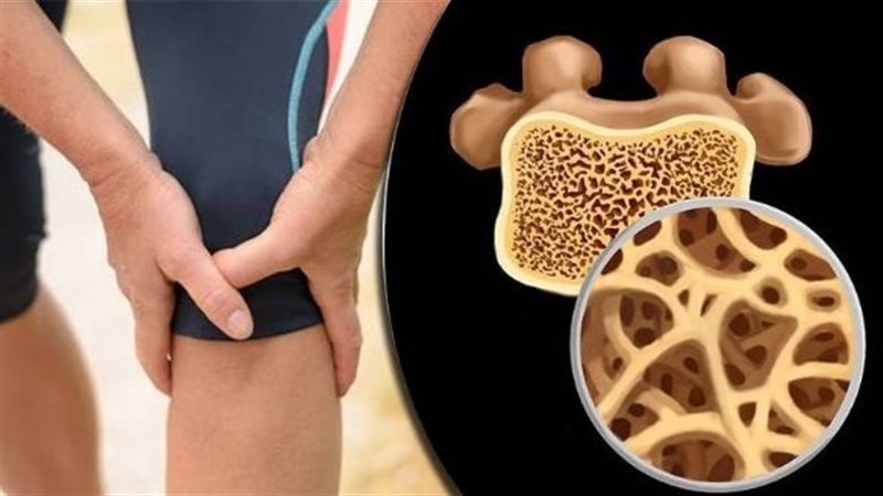 هشاشة العظام 