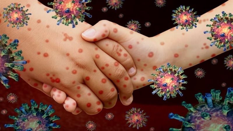 فيروس HFMD عند الكبار