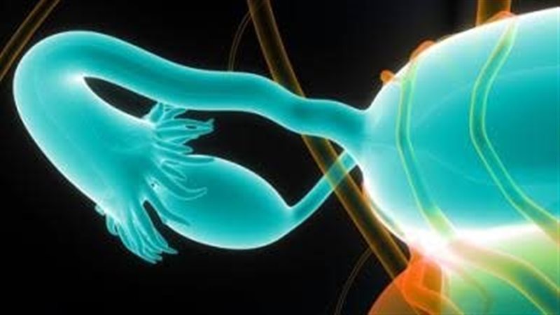 سرطان المبيض 