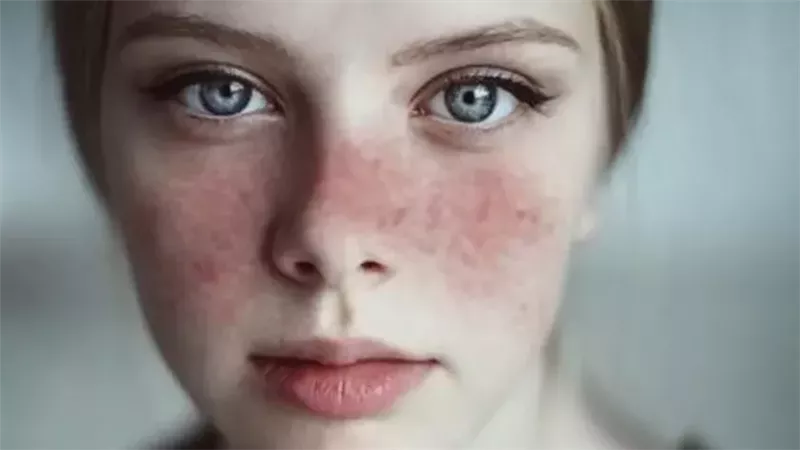 مرض الذئبة الحمراء