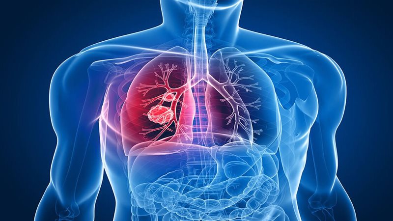 سرطان الرئة 