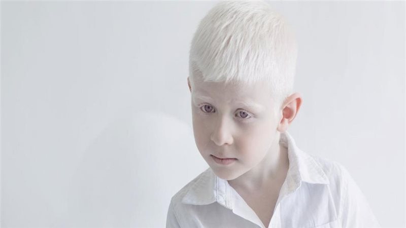 مرض الألبينو