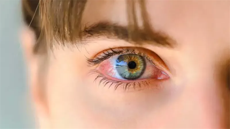 مشكلات العين 