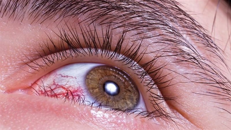 حساسية العين 