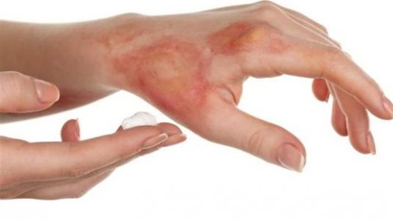 حروق الدرجة الثانية