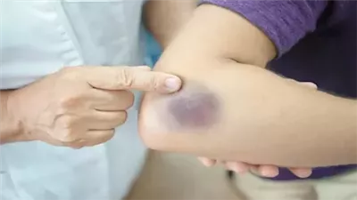 أسباب الكدمات المتكررة لدى مريض السكري وطرق علاجها