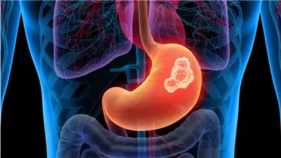 خطر خفي وراء أعراض بسيطة.. علامات تحذيرية  لسرطان المعدة