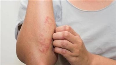 التوتر والإكزيما.. كيف يؤثر الضغط النفسي على الجلد