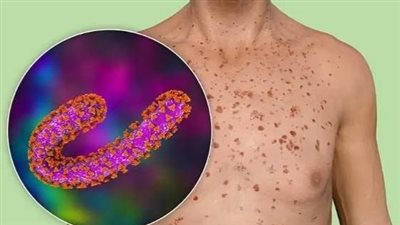 أسباب «فيروس ماربورج» وطرق انتشاره لدى البشر