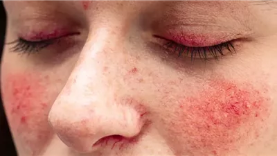  كيف نتعايش الأمراض المناعية ونواجه أعراض الذئبة الحمراء؟ 