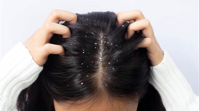 مع برودة الشتاء علاجات طبيعية للتخلص من قشرة الشعر