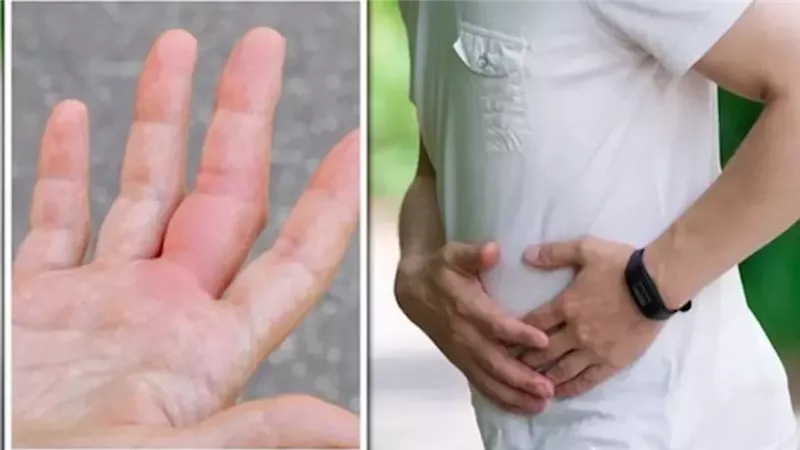 أعراض أمراض الكبد