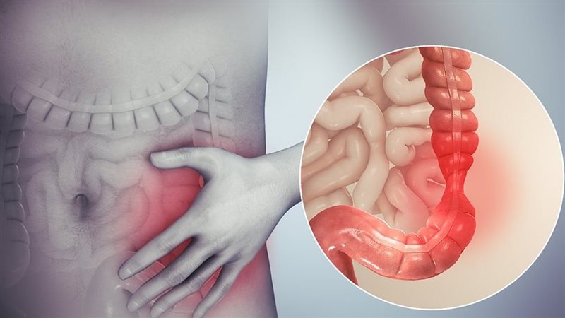 سرطان القولون 