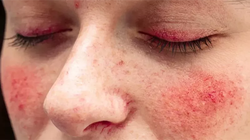 مرض الذئبة الحمراء