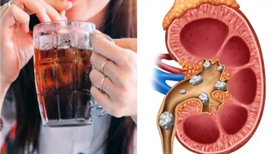 تحذير طبي.. مشروب شائع يضر الكلى أكثر الملح