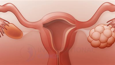 القرفة والكركم الأبرز.. توابل فعالة لعلاج تكيس المبايض
