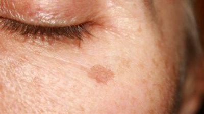 بقع الشمس أو بقع العمر.. أسبابها وطرق حماية البشرة