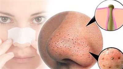 تخلصي من بثور الأنف بخطوات سهلة وفعالة