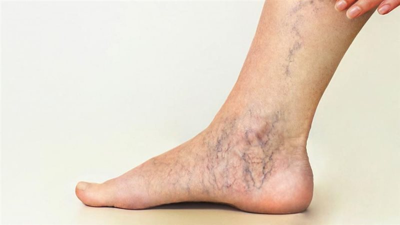 الأكزيما الوريدية