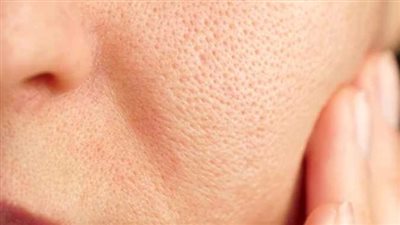 بمكونات بسيطة.. علاج المسام الواسعة بالوصفات الطبيعية