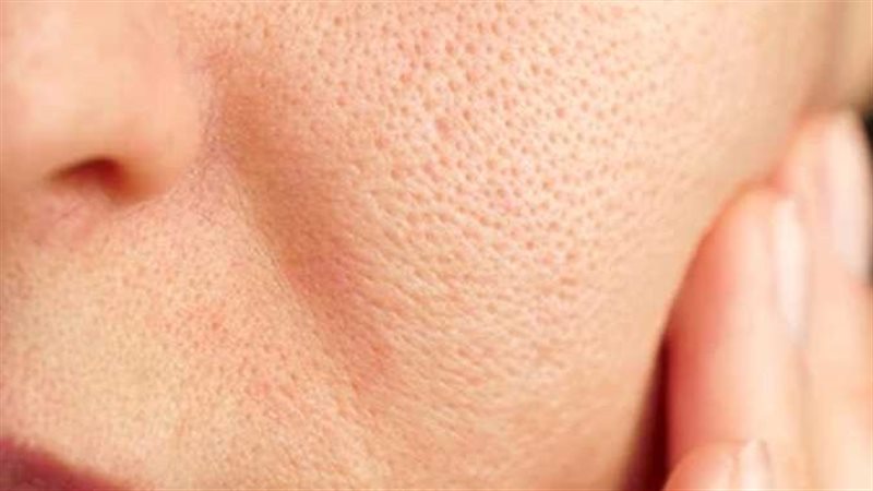 المسام الواسعة